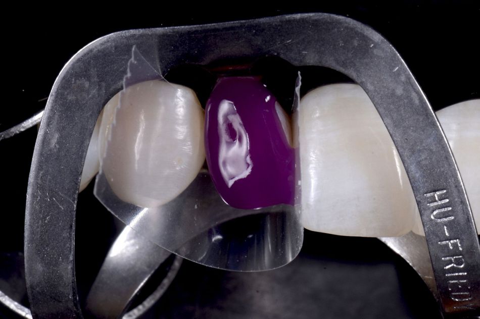 Fig. 59: Acid-etching of enamel: Note how the adjacent teeth were protected from the injury of the acid.