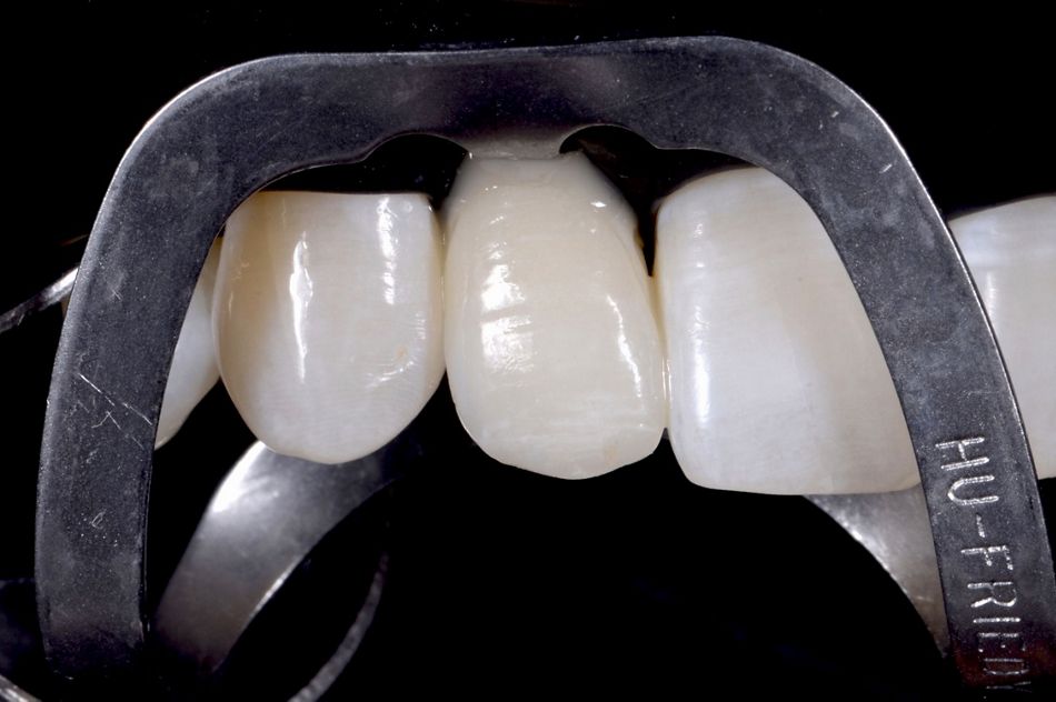Fig. 60: Cementation of the ceramic veneer with flowable composite.