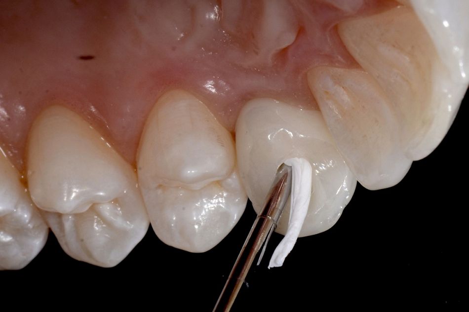 Fig. 61: After the tightening of the crown at 25 n/cm, the screw head was protected by using a teflon floss and the screw channel was filled with composite.