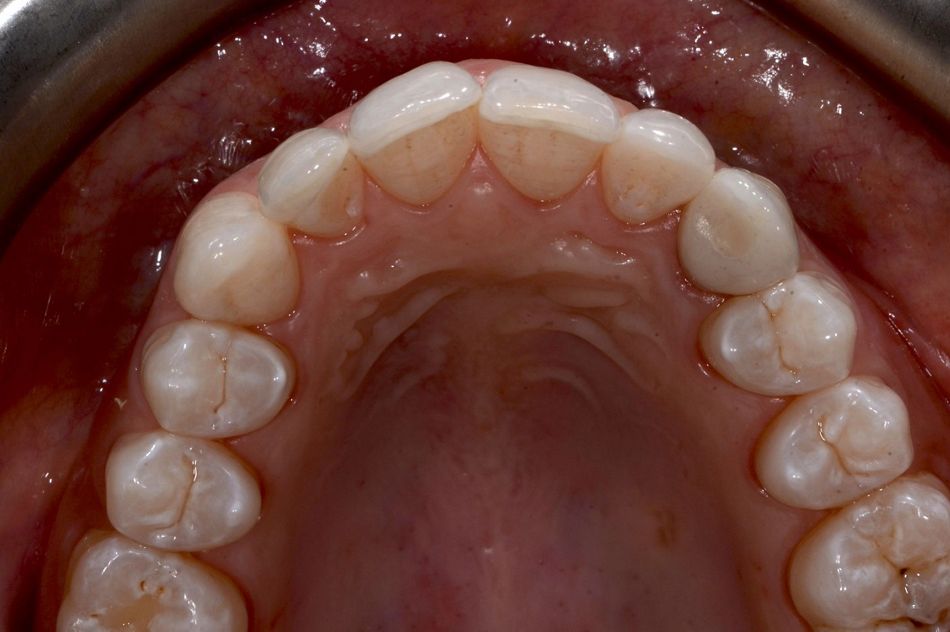 Fig. 62: Final occlusal view.