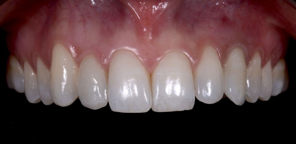 Fig. 63: Frontal view of the final result.