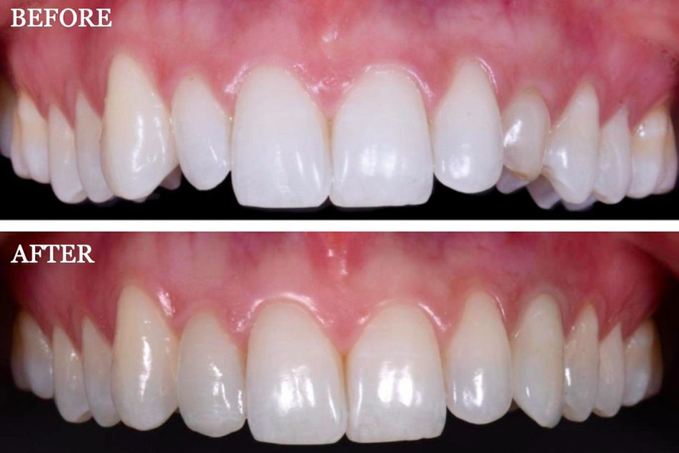 Fig. 64: Before and after the treatment: Note how the smile of the patient was improved simply by modifying the shapes of 12 and 23