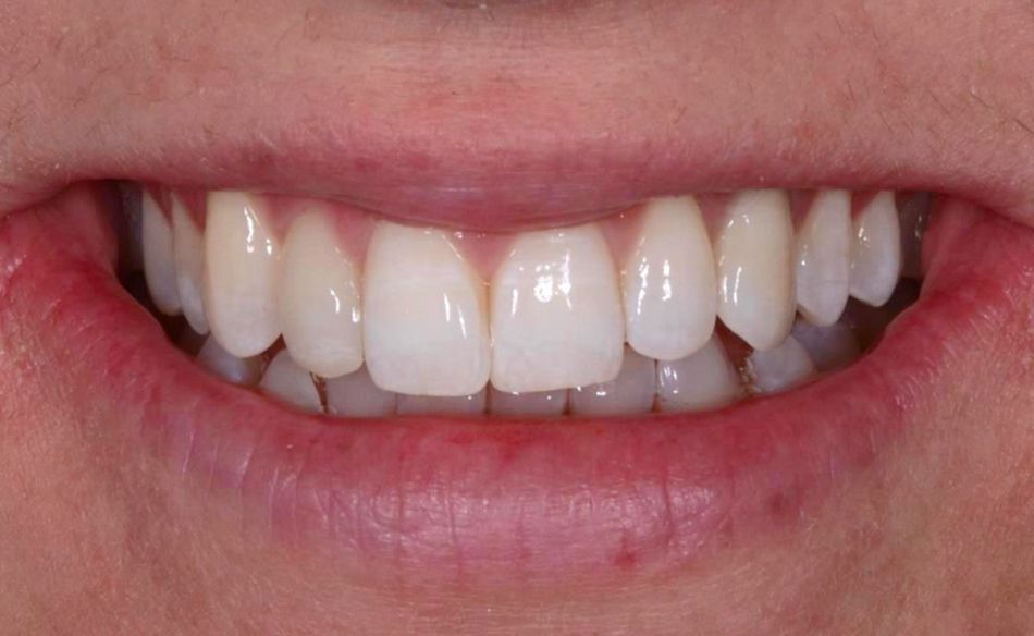 Fig. 65: The pleasant smile of the patient