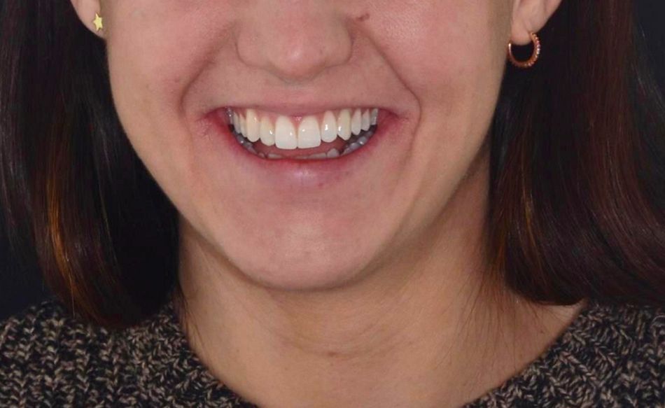 Fig. 66: New smile is harmoniously integrated in the patient’s face