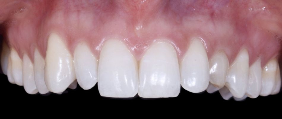 Fig. 6: Intraoral view: The discrepancy between upper canines and  lateral incisors is clear. Note that the deciduous tooth is shorter than the contralateral, both at the occlusal and at the gingival side.