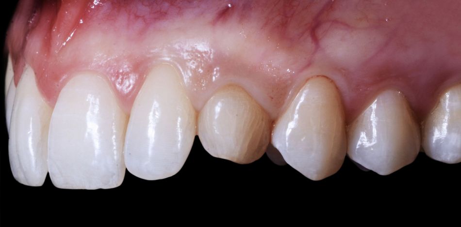 Fig. 7: Magnification of the deciduous tooth: A wide amount of keratinized gingiva is shown.