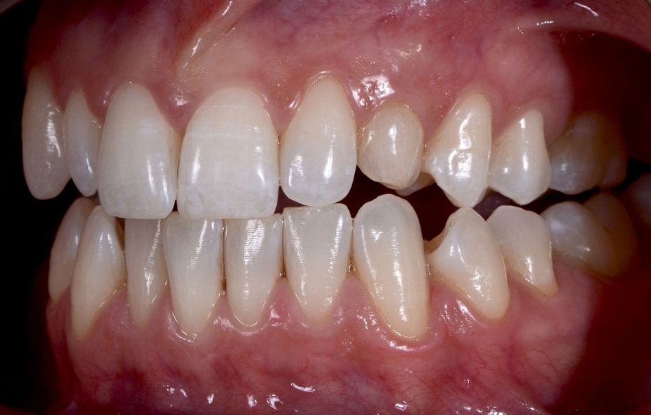 Fig. 8: The functional analysis revealed that the canine guidance was given by lateral incisor and first premolar whilst the deciduous canine was not involved.
