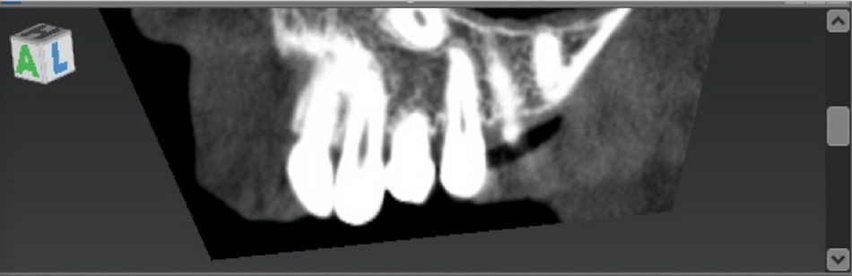Fig. 9: Cone Beam Computed Tomography (CBCT) exam shows the presence of the impacted canine.