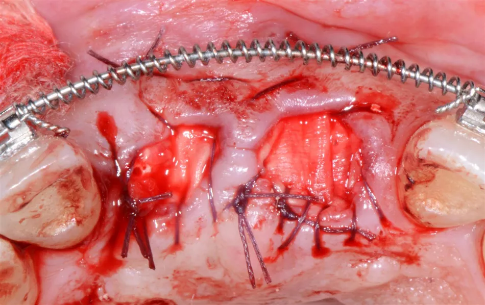 Fig. 10: The Jason® membrane is also indicated for ridge preservation procedures (case by Dr. Damir Jelušić, Opatija, Croatia).