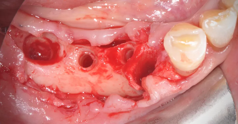 Fig. 8: Due to its elasticity and strength, the Jason® membrane shows special benefits in large augmentation procedures (case by Dr. Massimo Frosecchi).