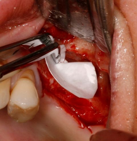 Abb. 3: Nach der Präparation des lateralen Sinusfensters wird ein individuell zugeschnittener Teil der trockenen Jason® membrane in die Kavität eingebracht.