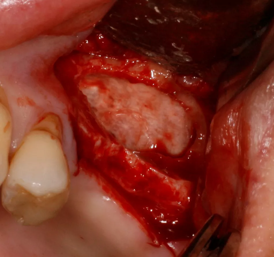 Fig. 4: The re-hydrated membrane protects the Schneiderian membrane prior to the placement of graft material.