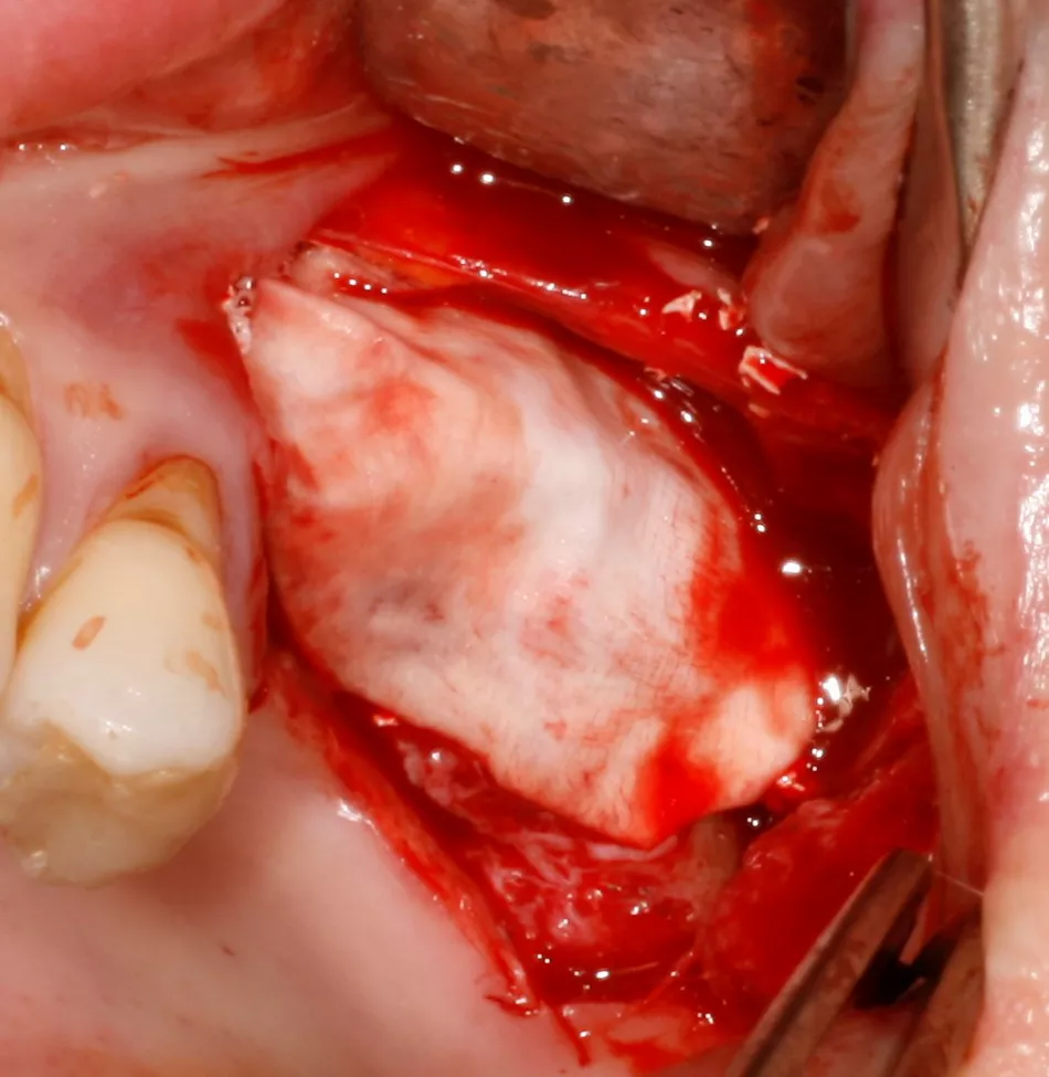 Fig. 5: After application of the bone substitute material for both sinus augmentation and lateral augmentation, a second Jason® membrane is placed on the graft for long-term separation from the soft tissue.