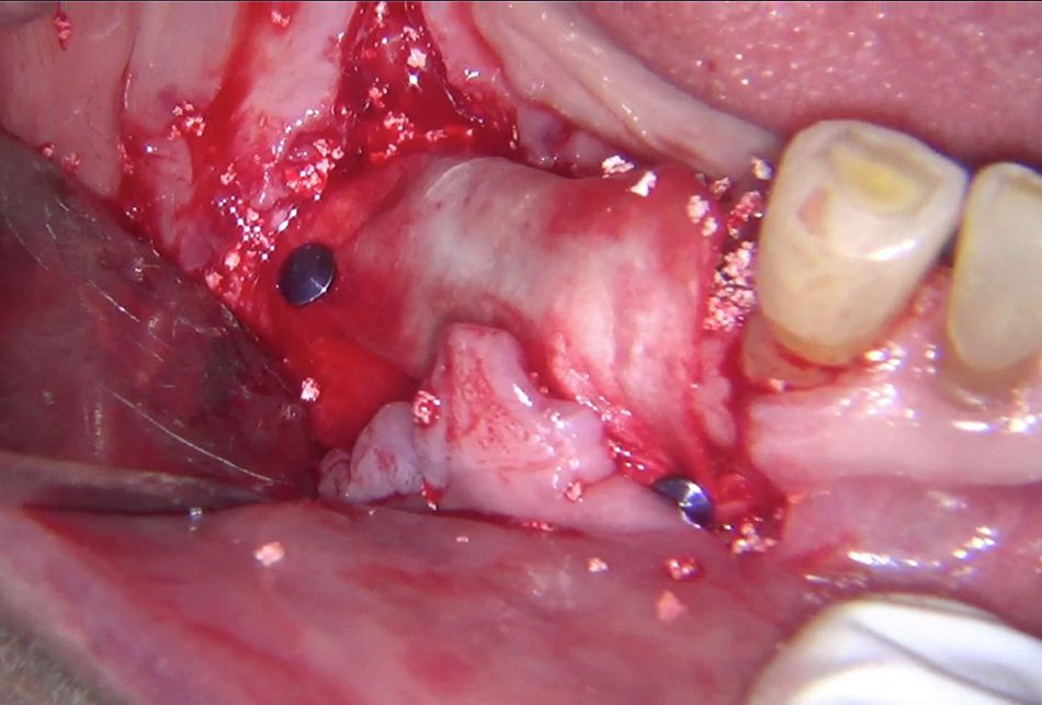 Fig. 9: The membrane was used in combination with botiss maxresorb®, mixed with autogenic bone.