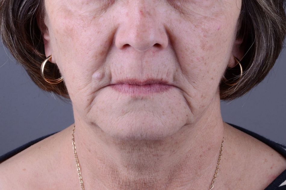 Figure 1. Baseline situation. Extraoral aspect.