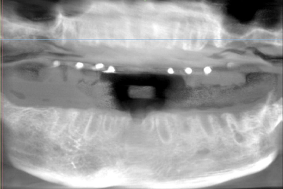 Figure 10. CBCT panoramic view showing gutapercha points in the sites of interest. 