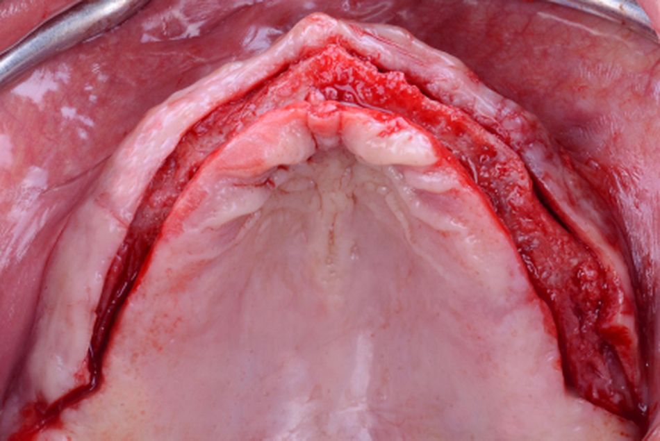 Figure 11. Maxillary implant surgery. Occlusal view of the alveolar ridge before implant placement.