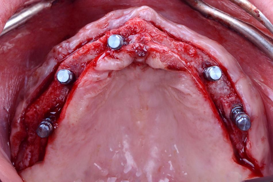 Figure 12. Maxillary implant surgery. Occlusal view of the implants placed, one in right central incisor, two in right and left canine and two in second premolar sites.