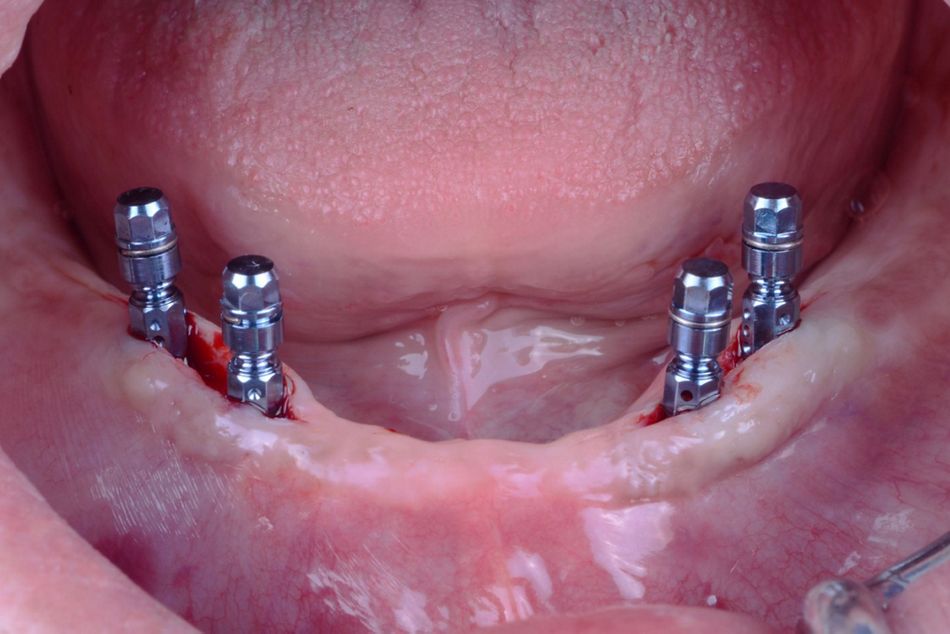 Figure 13. Mandibular implant surgery. Frontal view of the four implants placed. 