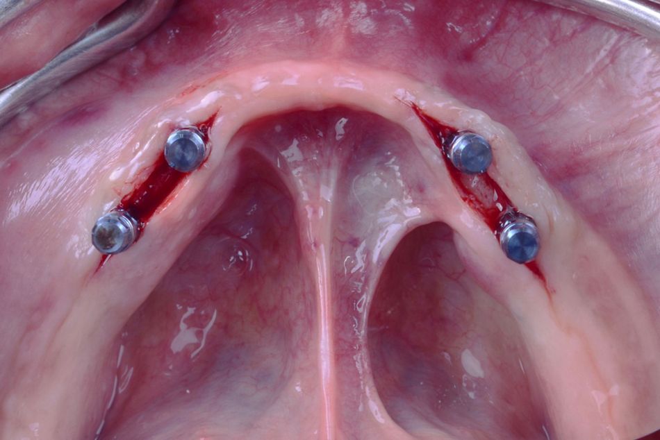 Figure 14. Mandibular implant surgery. Occlusal view of the four implants placed in straight position. 