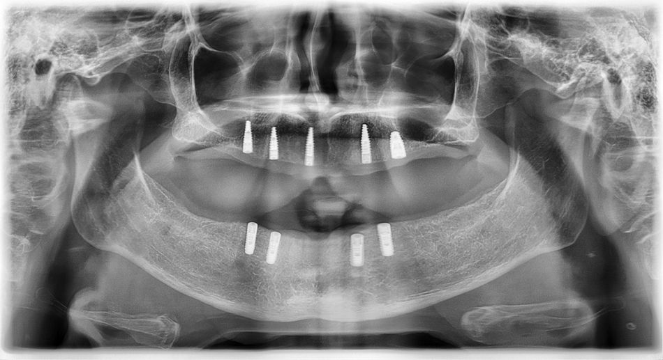 Figure 15. Panoramic X-ray after 8 weeks postoperative healing period. 