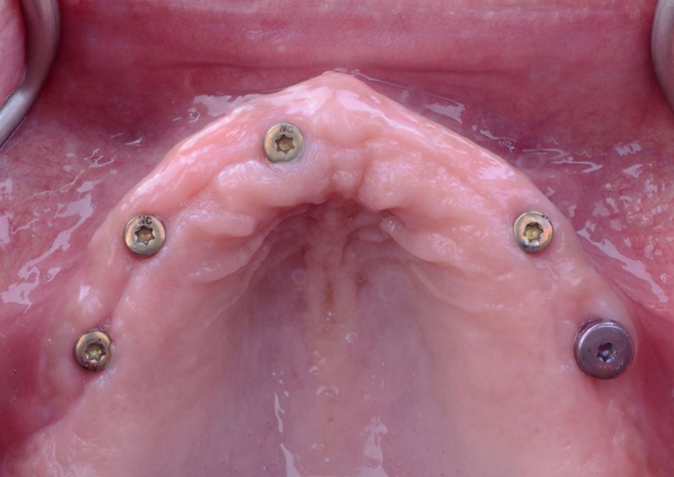 Figure 16. Occlusal view of the five maxillary uncovered implants.
