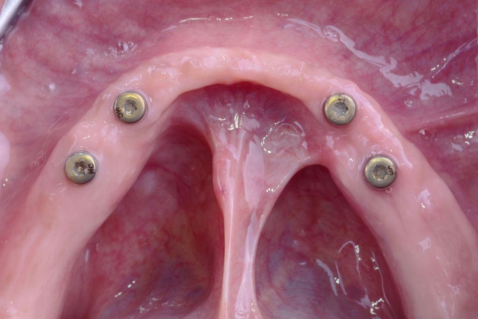 Figure 17. Occlusal view of the four uncovered implants placed in the lower jaw. 