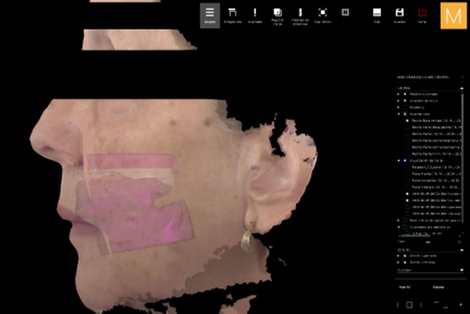 Figure 18. 3D digitization of the patient’s face in the natural head position with upper and lower baseplates and wax rims with the correct inter-maxillary parameters.