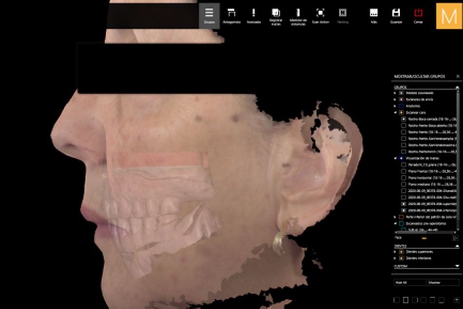 Figure 19. Facial data integrated into the virtual articulator with final virtual design of the restorations. 