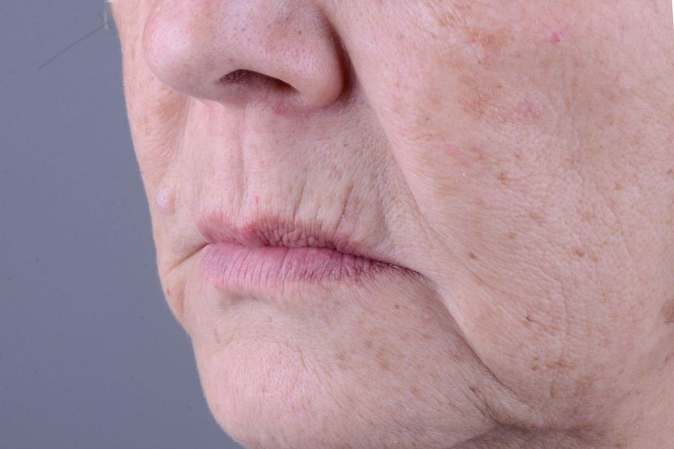 Figure 2. Baseline situation. Extraoral aspect.