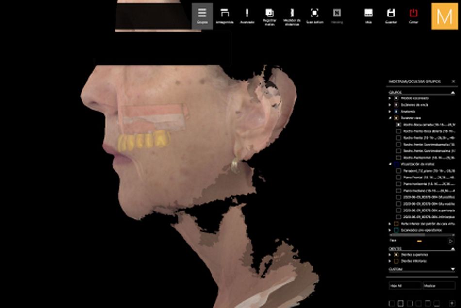 Figure 20. Facial data integrated into the virtual articulator with final virtual design of the maxillary restoration. 