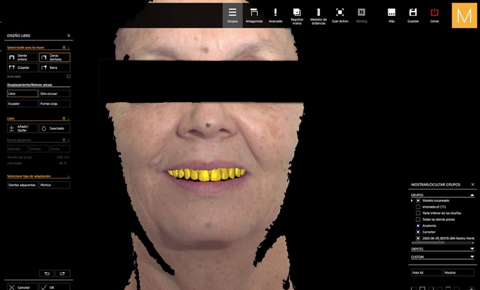 Figure 21. Facial data integrated into the virtual articulator with final virtual design of the restorations. 