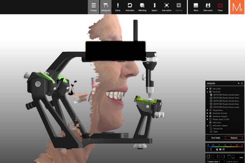 Figure 22. Facial data integrated into the virtual articulator with final virtual design of the maxillary and mandibular restorations. 