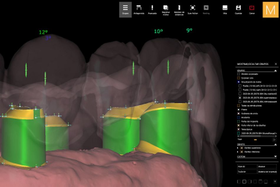 Figure 23. Virtual design of the maxillary telescopic crowns. 