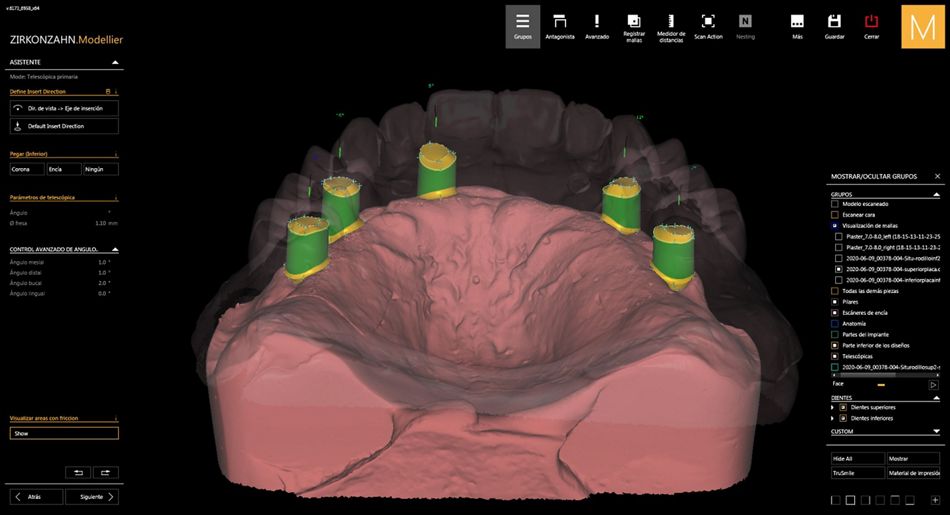 Figure 24. Virtual design of the maxillary telescopic crowns. 