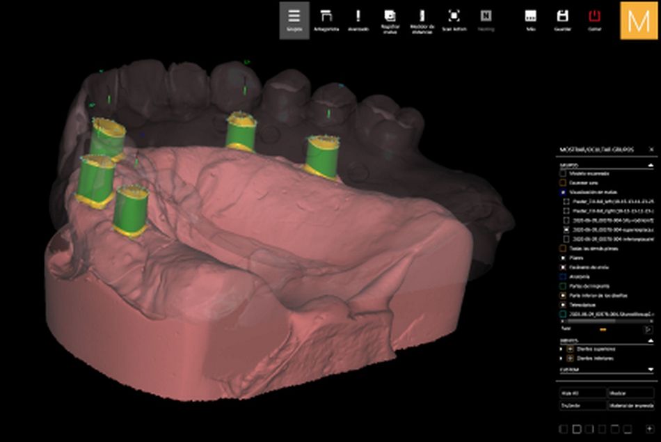 Figure 25. Virtual design of the maxillary telescopic crowns. 