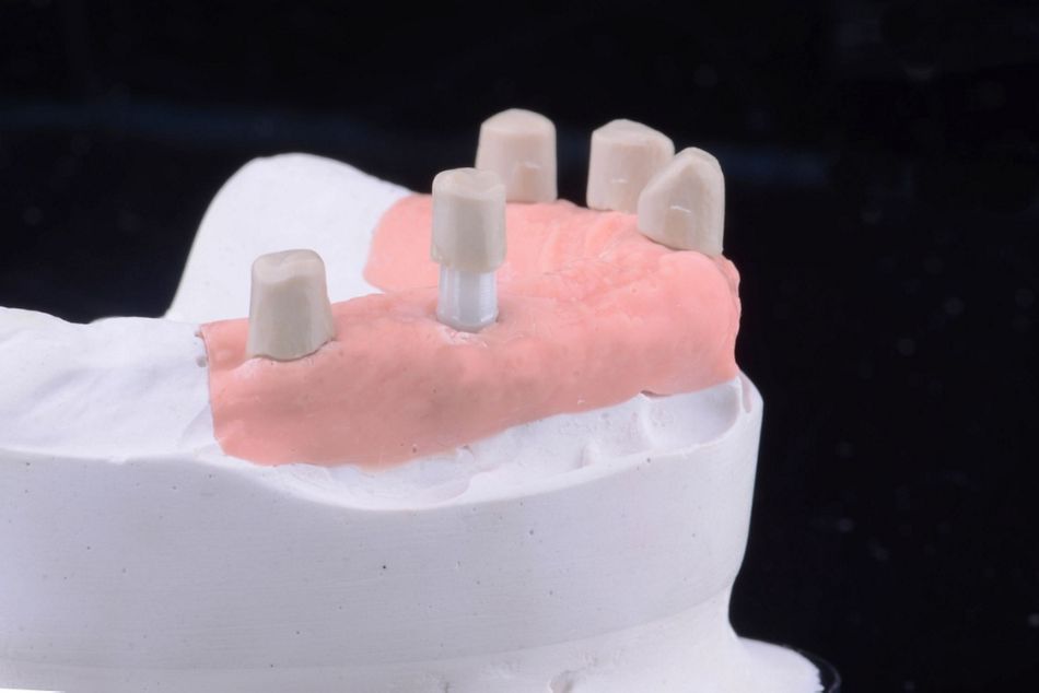 Figure 27. Secondary friction elements milled out in PEEK material. At the end they were cemented onto the final denture base structure.