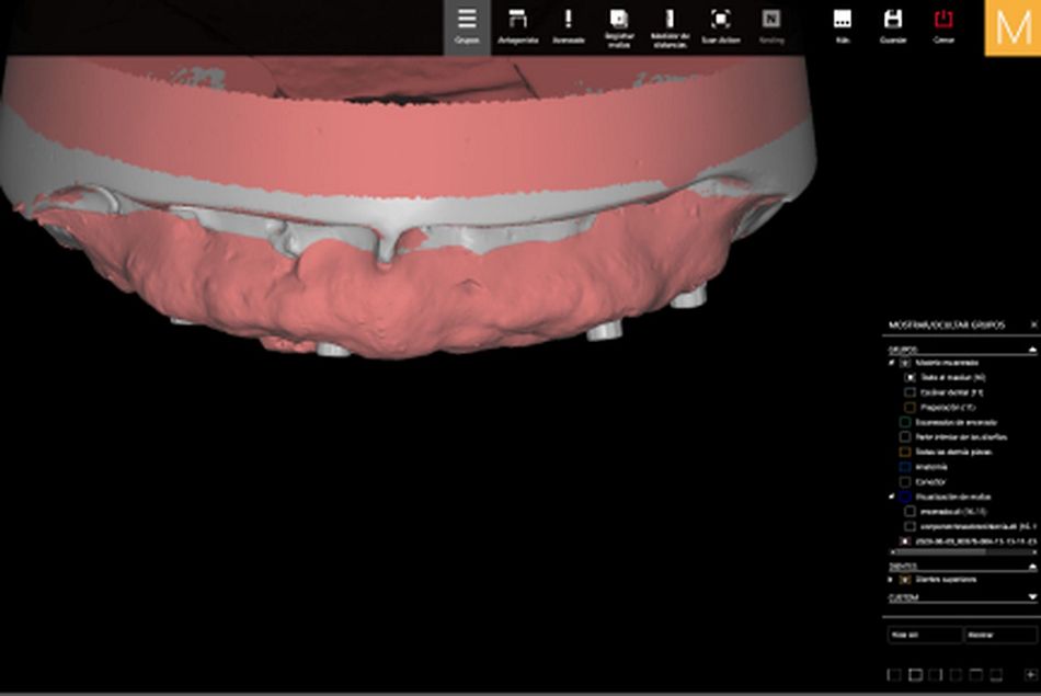 Figure 28. Final virtual design in the CAD software of the maxillary over denture before CAM procedure.