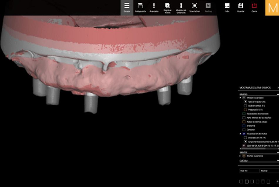 Figure 29. Final virtual design in the CAD software of the maxillary over denture before CAM procedure. 