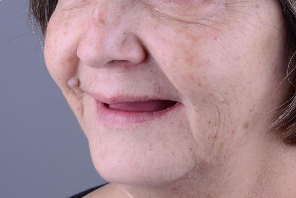 Figure 3. Baseline situation. Extraoral aspect. 