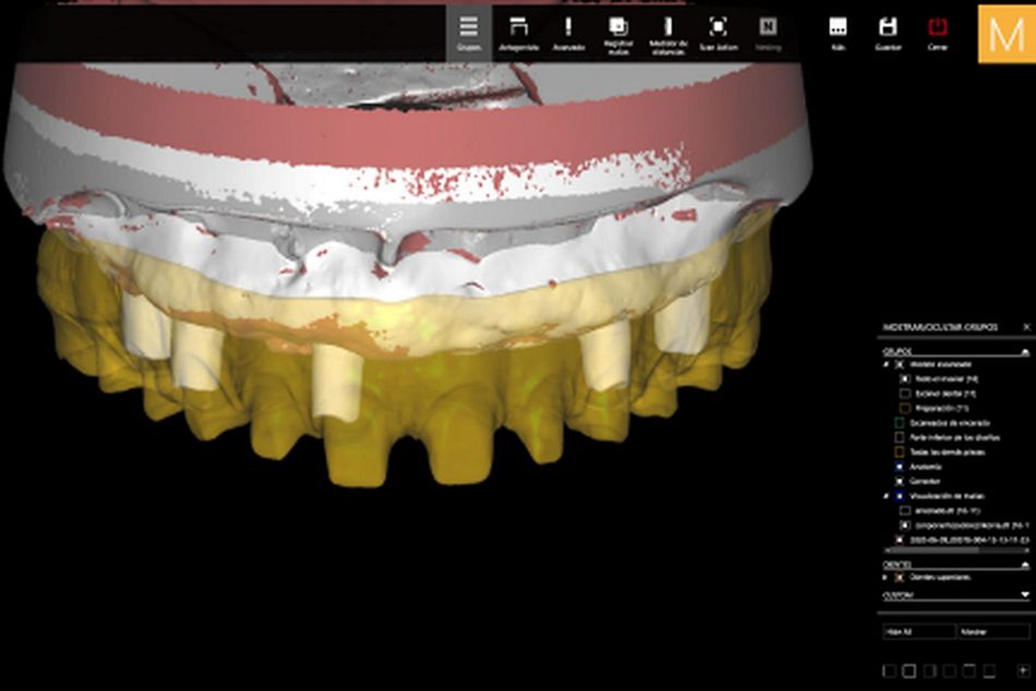 Figure 30. Final virtual design in the CAD software of the maxillary over denture before CAM procedure. 