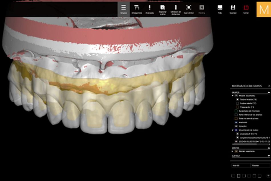 Figure 31. Final virtual design in the CAD software of the maxillary over denture before CAM procedure. 