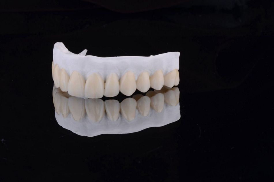 Figure 32. Maxillary overdenture base material milled out in reinforced PEEK. The customized ceramic denture teeth were milled out in lithium disilicate glass ceramic and finally were bonded to the reinforced denture base structure.
