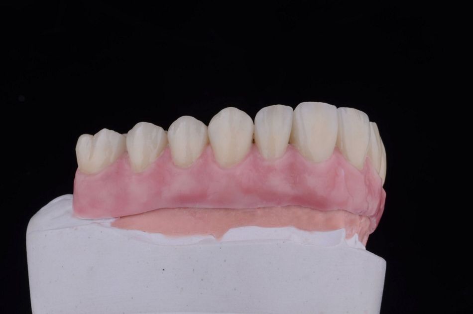 Figure 34. Final telescopic complete maxillary overdenture customized with pink veneering composite. 