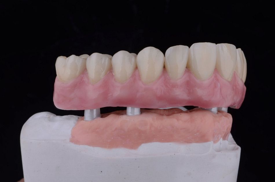 Figure 35. Final telescopic complete maxillary overdenture customized with pink veneering composite. 