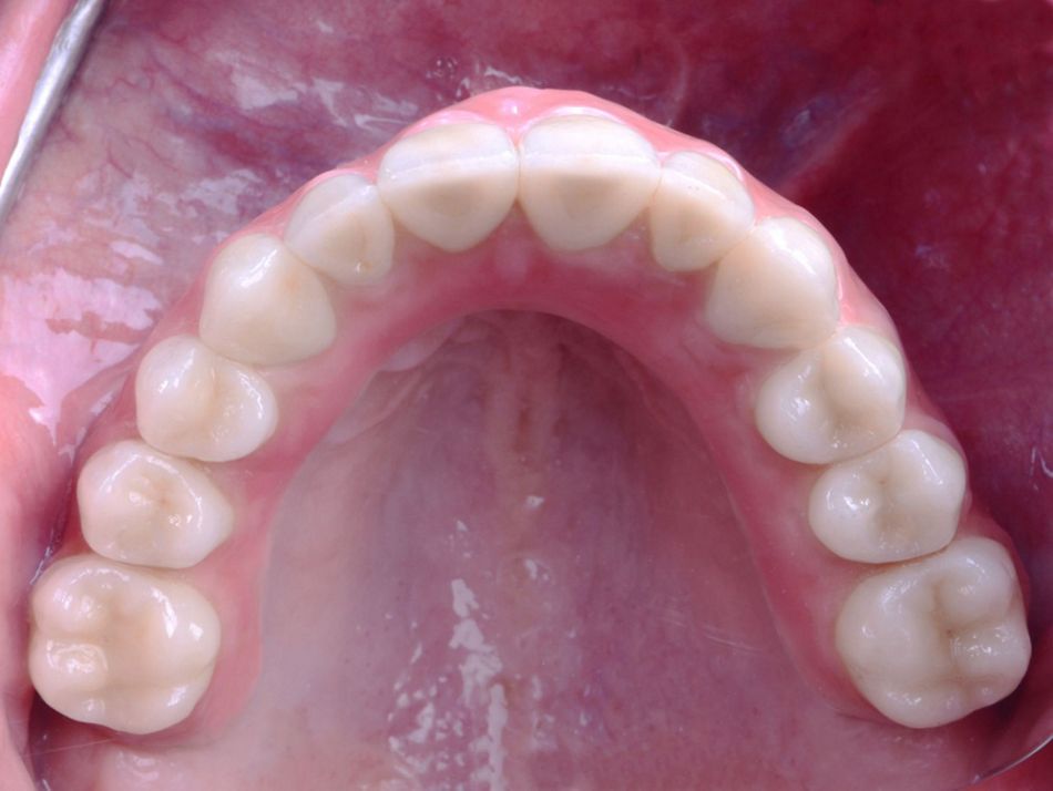 Figure 37. Intraoral occlusal view of the maxillary implant overdenture incorporated. 