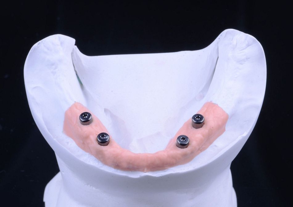 Figure 38. Novaloc abutments presented in the model with artificial soft tissue showing the correct abutment gingival height.