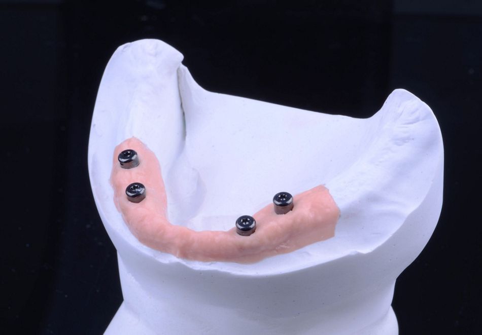 Figure 39. Novaloc abutments presented in the model with artificial soft tissue showing the correct abutment gingival height. 