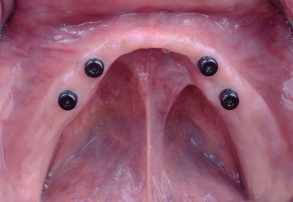 Figure 41. Intraoral occlusal view of Novaloc abutments screwed and torqued at 35Ncm.
