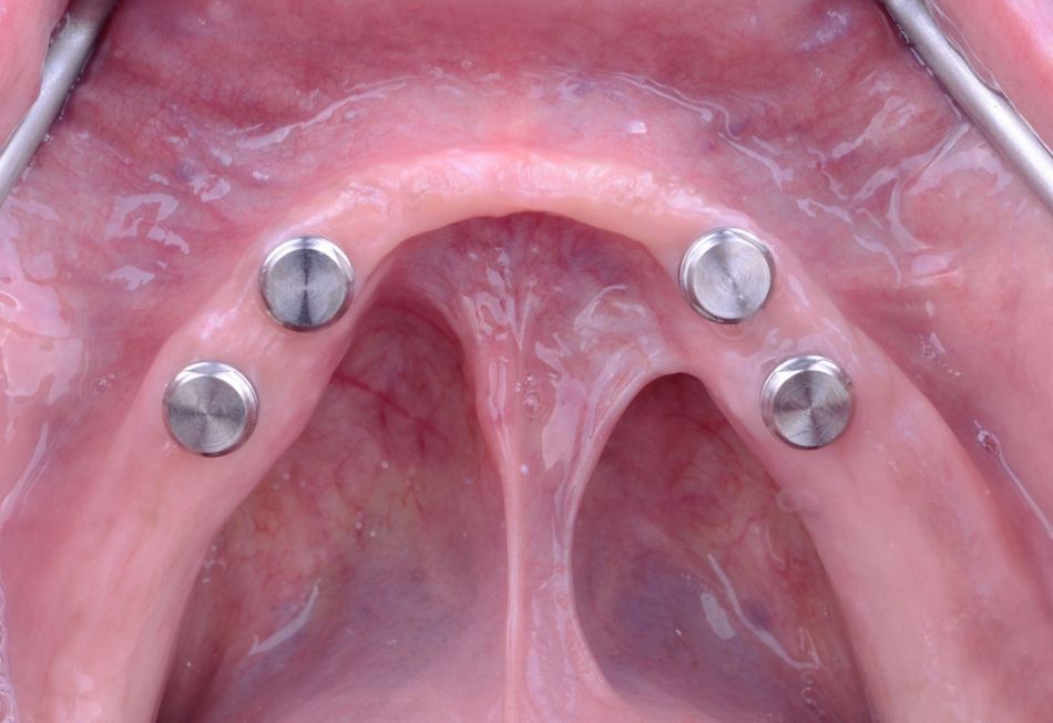 Figure 42. Intraoral direct pick up procedure. Titanium matrix housings in situ.